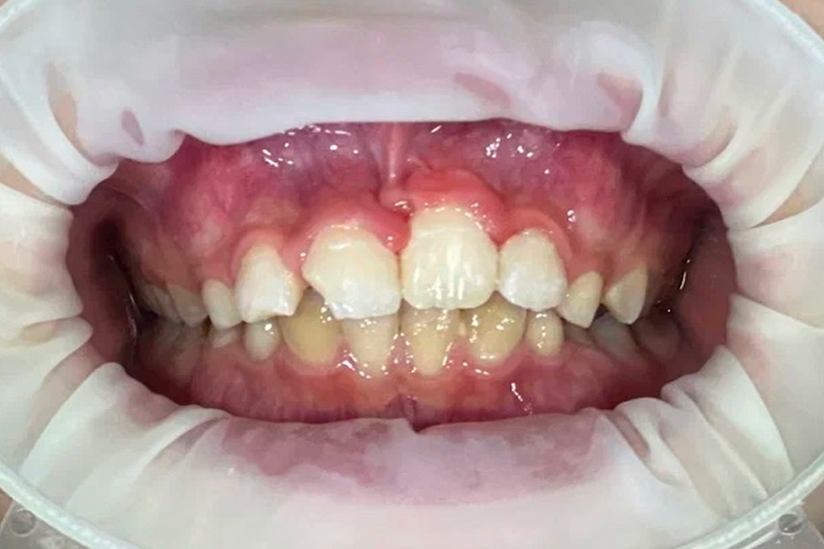 Хирургическое раскрытие ретинированных зубов - после