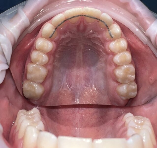 Исправление прикуса - после лечения