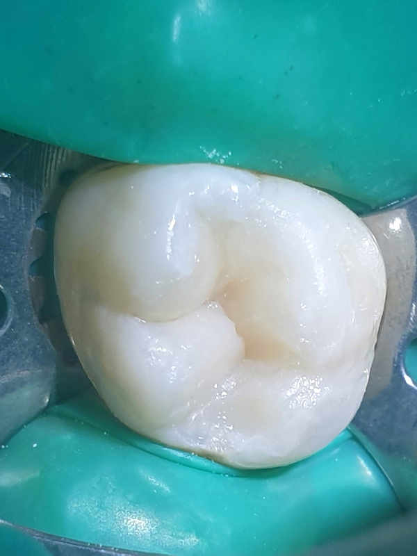 Лечение кариеса и реставрация - после