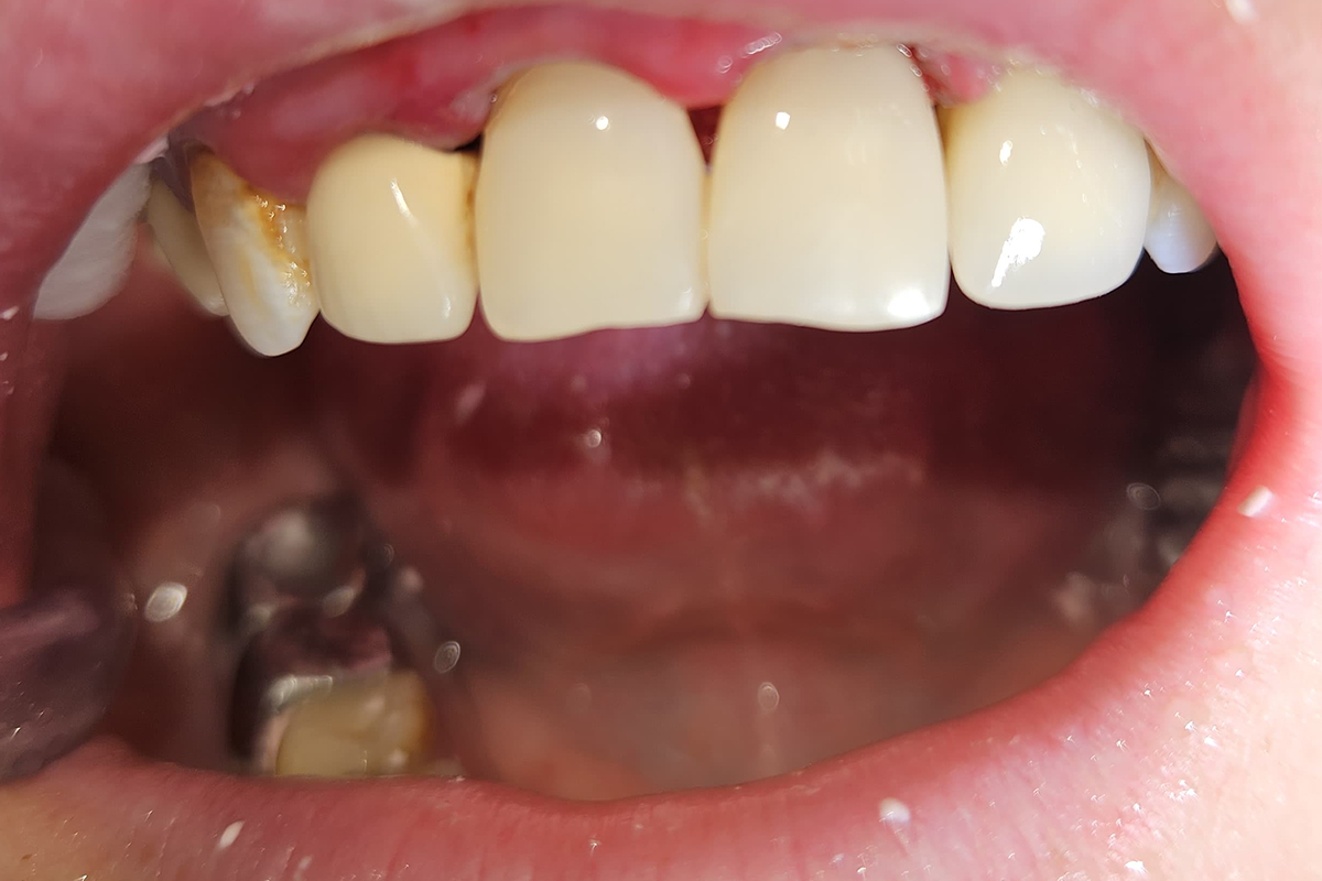 Реставрация зубов - после