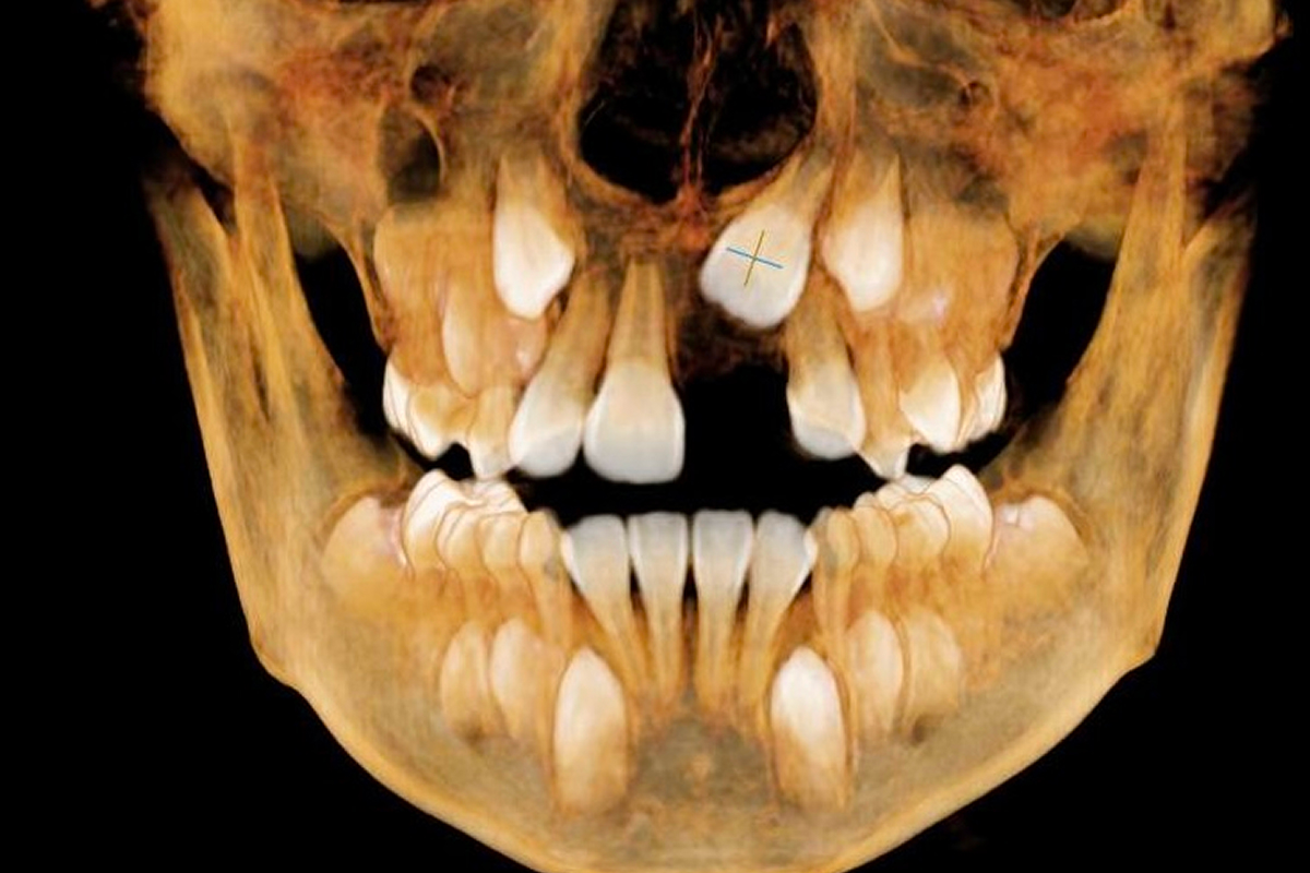 Хирургическое раскрытие ретинированных зубов - до