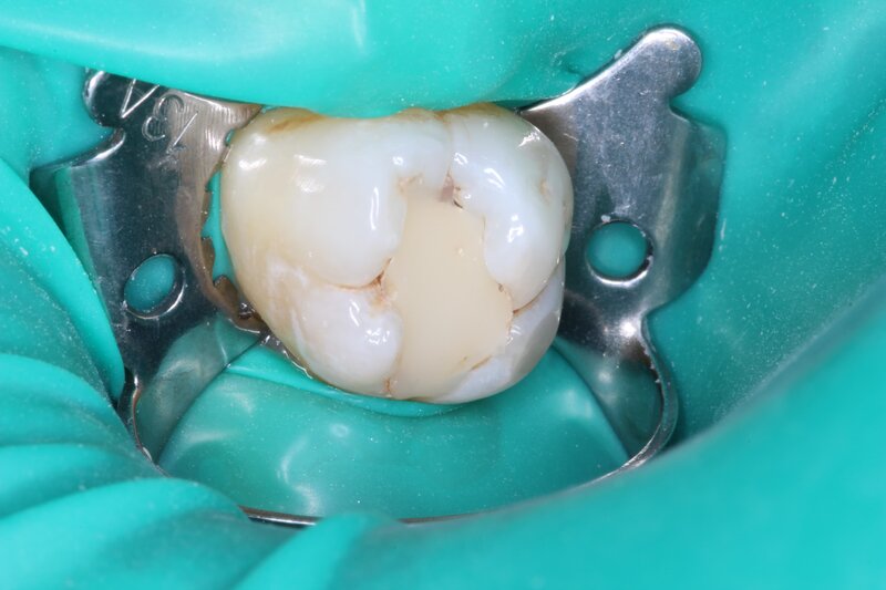 Лечение кариеса и реставрация - до