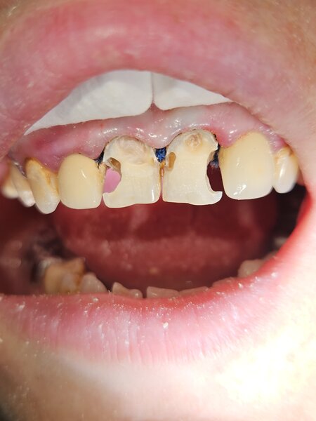 Реставрация зубов - до